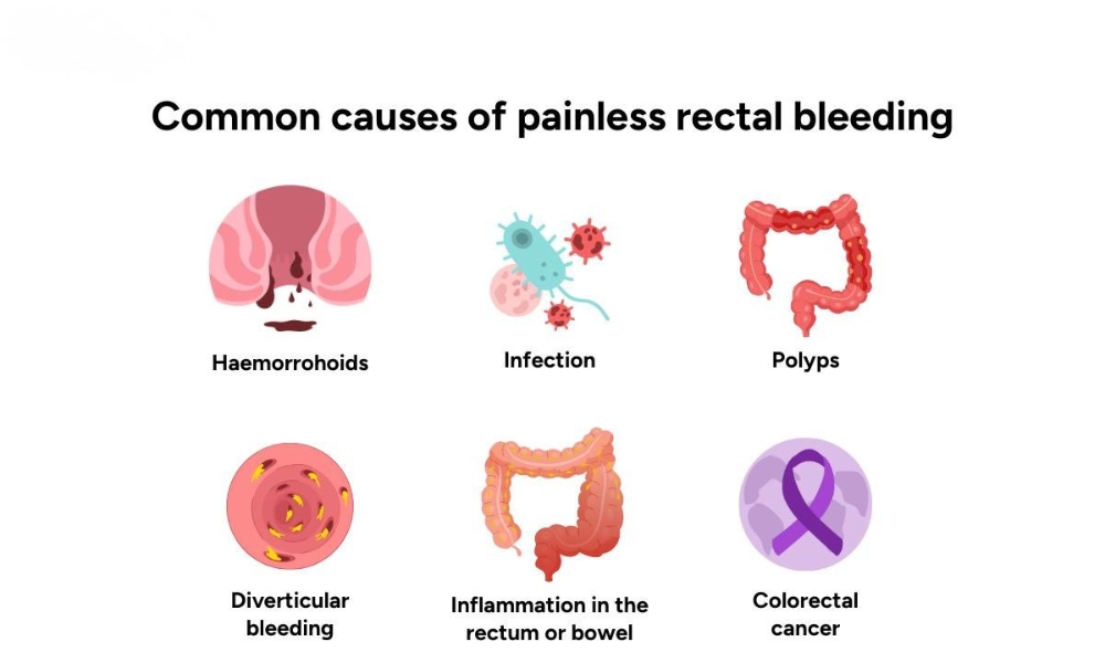 rectal bleeding evaluation