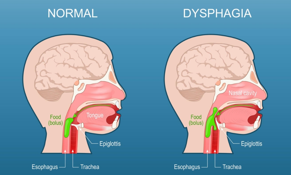 trouble swallowing food