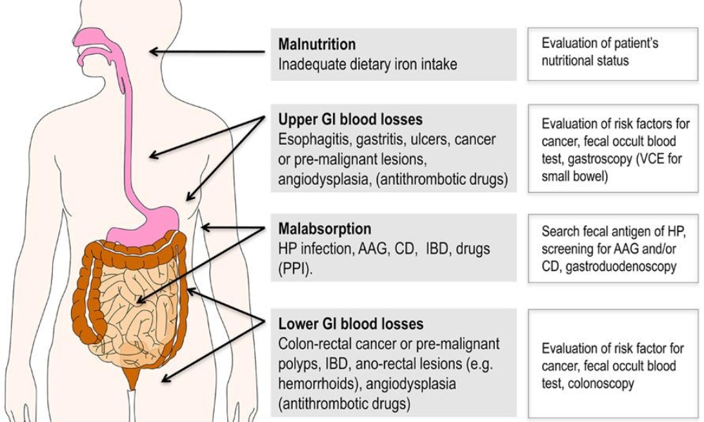 endoscopy for anemia