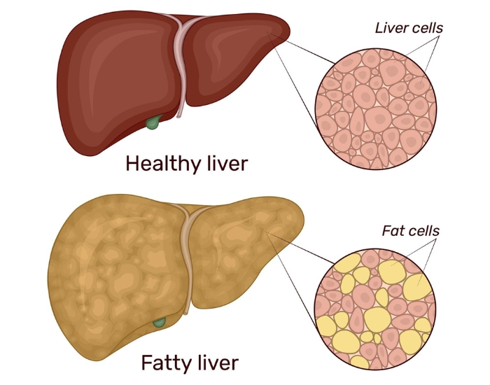 abnormal liver enzymes high ALT and AST